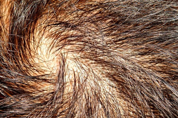 hair follicles