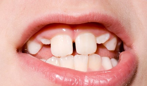 Straighten Overlapping Teeth