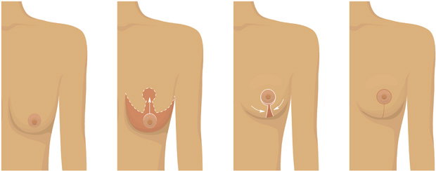Breast Lift Procedure Inverted T Anchor Lift (mastopexy)