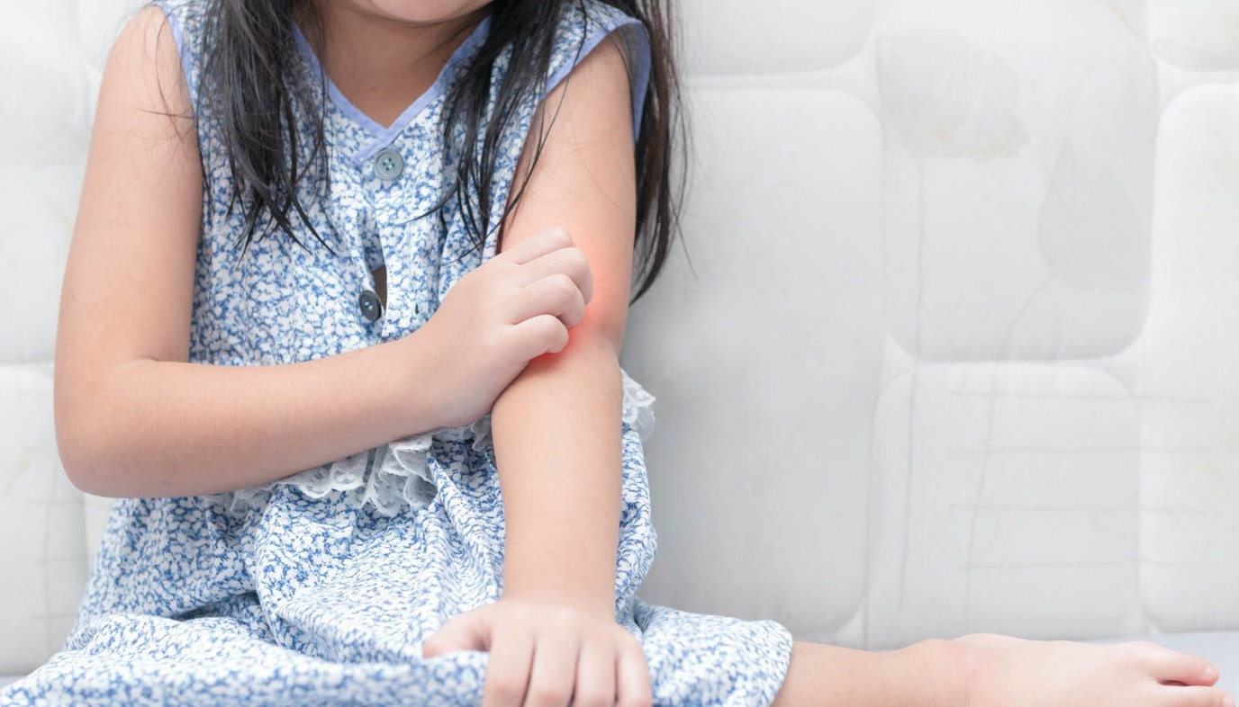 girl scratching rash on arm