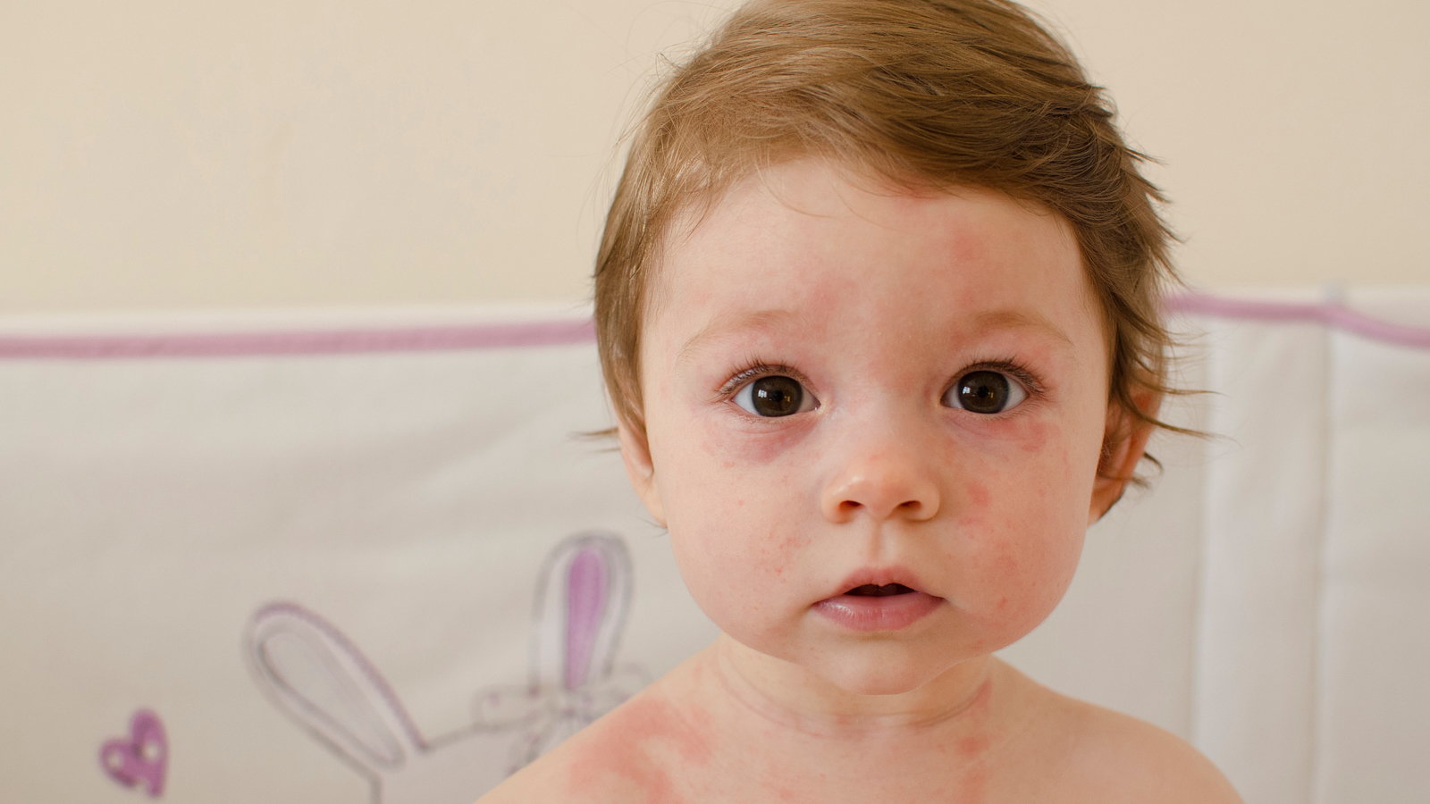baby with rash on face and body