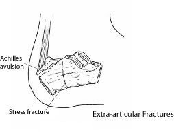 Calcan Fractures 2 Calcan Fractures 2