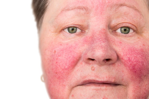woman with hives after excessive alcohol consumption