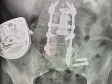 My back with 10 (3” lag bolts)