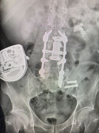 My back with 10 (3” lag bolts)