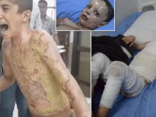 Kurdish kids  after white phosphorus and other chemical burns