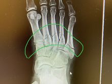 All five metatarsals broke. 