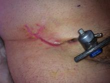 Hardware holding my pelvis together whileI healed