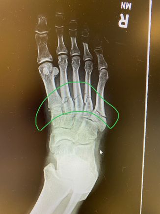 All five metatarsals broke. 