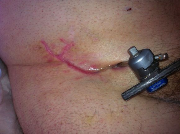 Hardware holding my pelvis together whileI healed