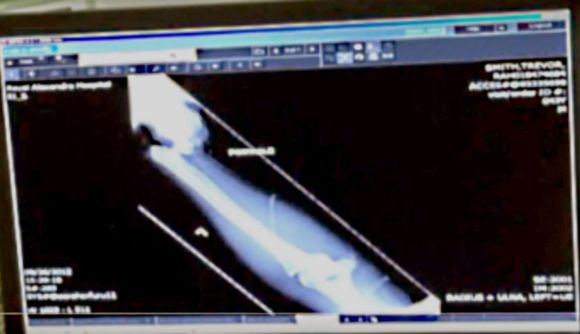 left wrist after repositioning for x-ray 92 minutes after accident.  the hand was hanging off my left elbow